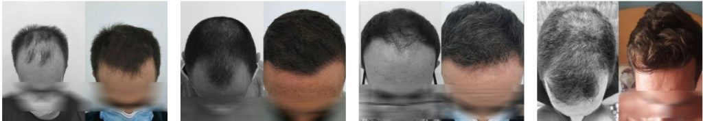 resultados-antes-y-despues-capilclinic-madrid-1