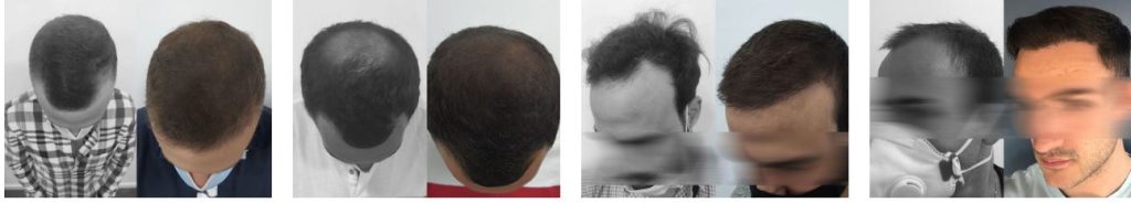 resultados-antes-y-despues-capilclinic-madrid-2